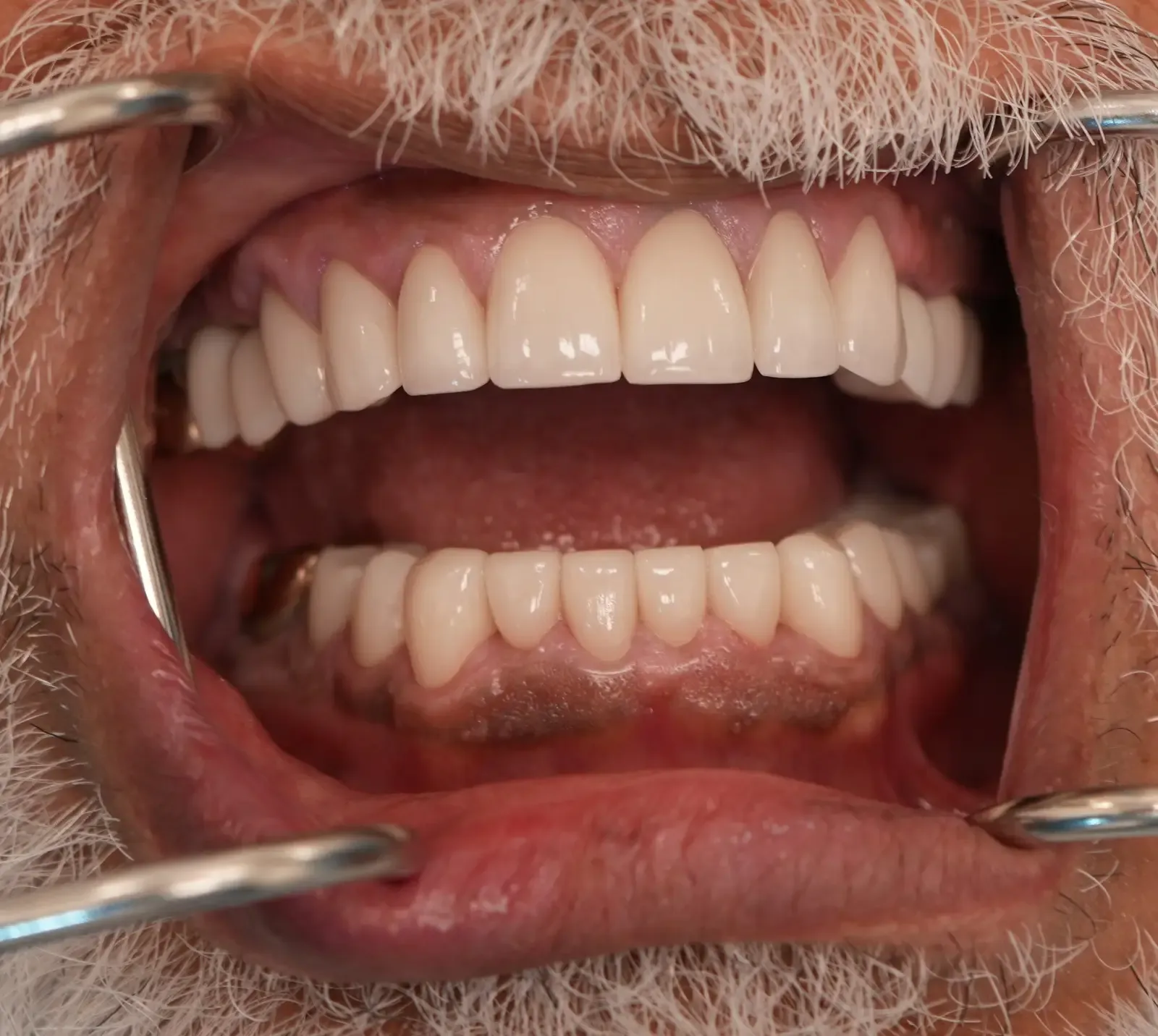 Foto después del tratamiento dental del paciente 1