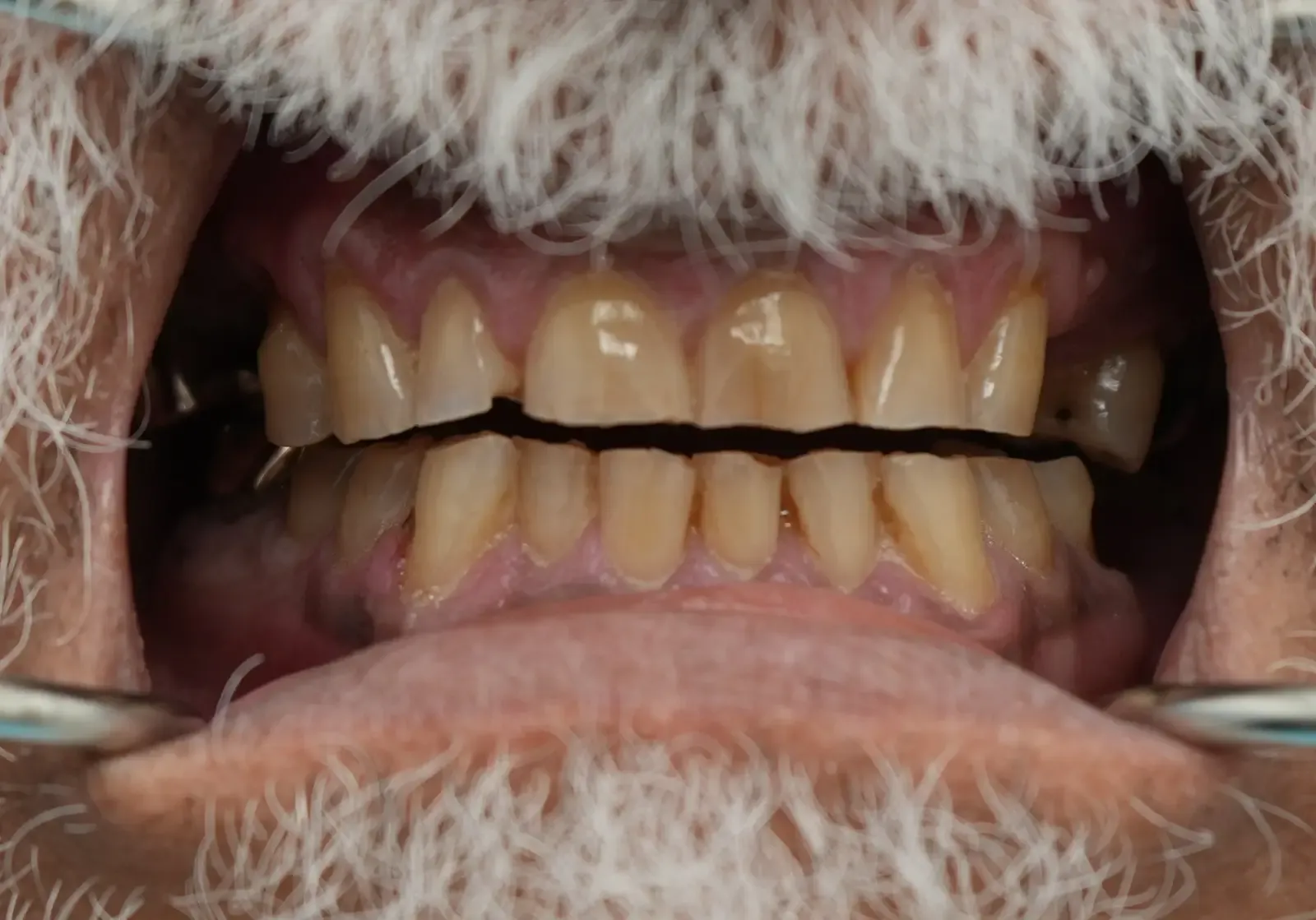 Foto antes del tratamiento dental del paciente 1