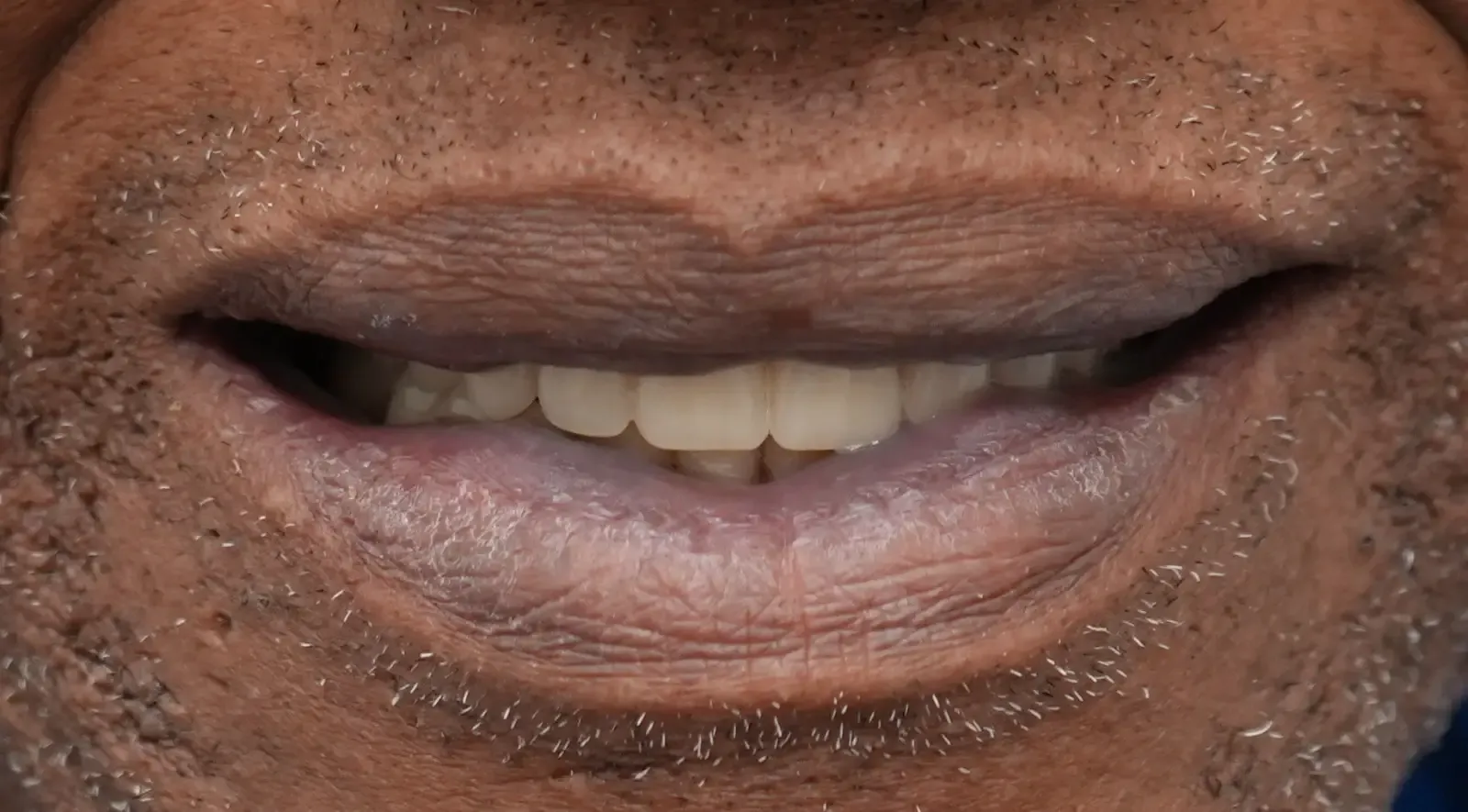 Foto después del tratamiento dental del paciente 2