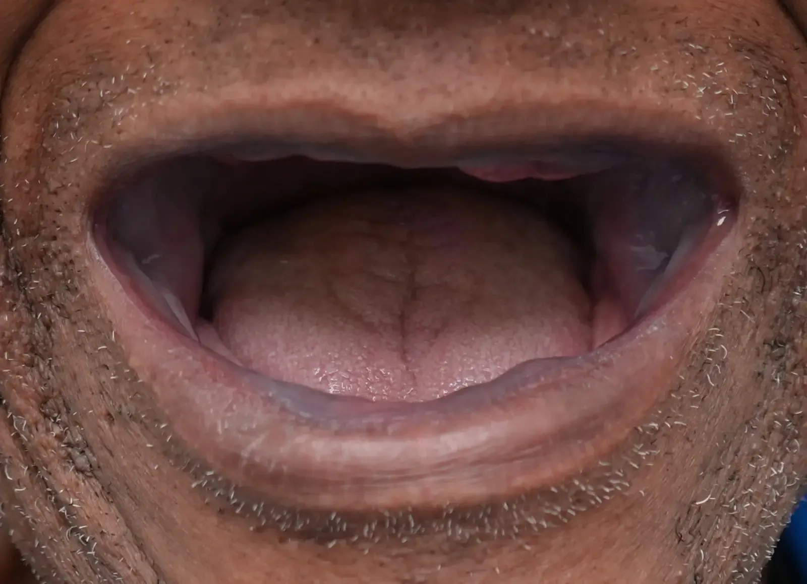 Foto antes del tratamiento dental del paciente 2