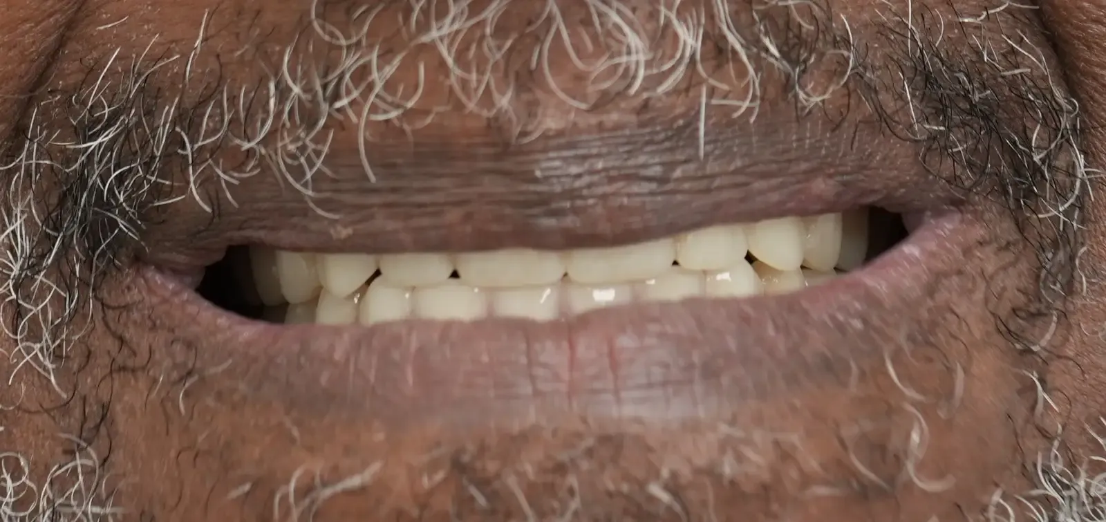 Foto después del tratamiento dental del paciente 3