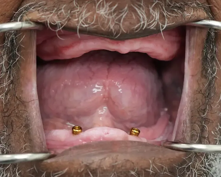 Foto antes del tratamiento dental del paciente 3