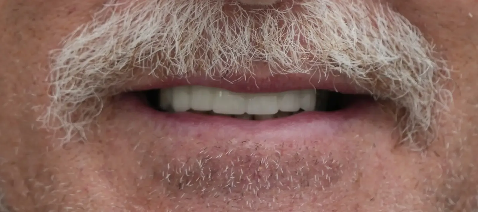 Foto después del tratamiento dental del paciente 4
