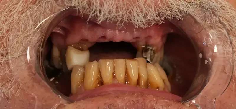 Foto antes del tratamiento dental del paciente 4