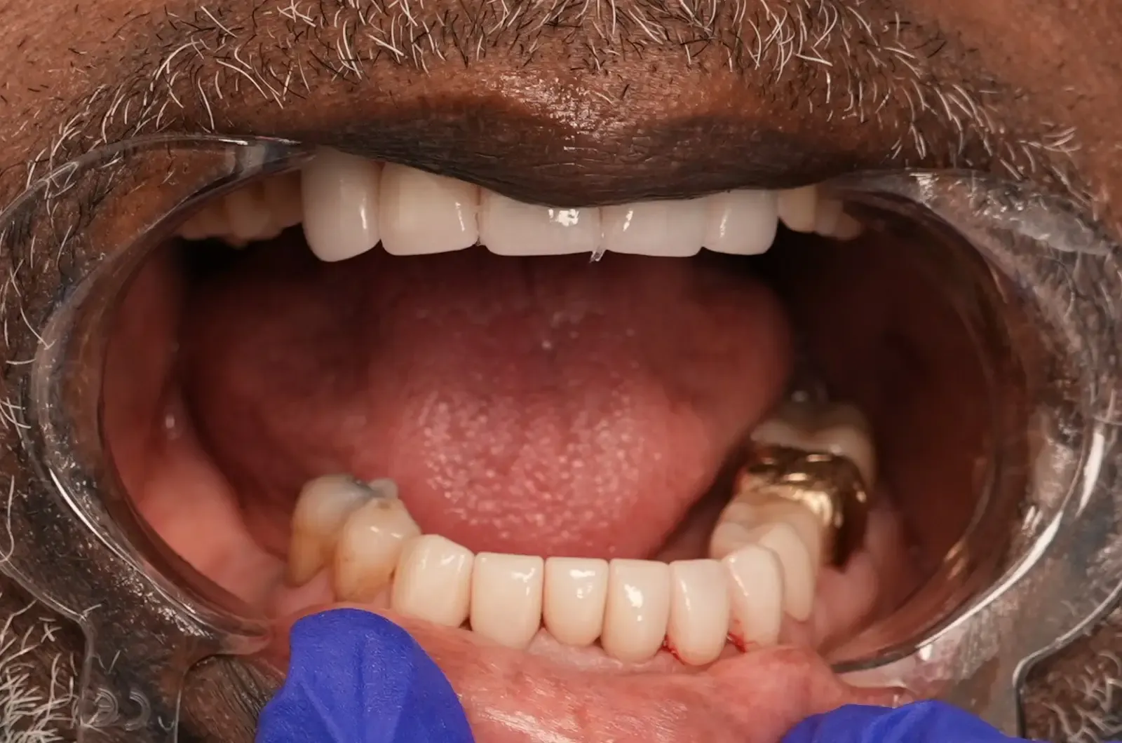 Foto después del tratamiento dental del paciente 5