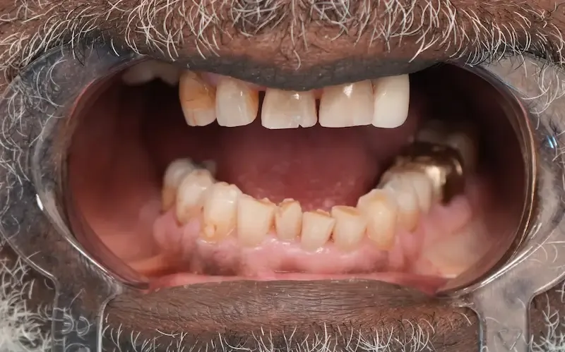 Foto antes del tratamiento dental del paciente 5