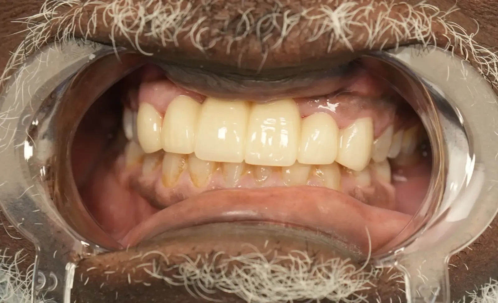 Foto después del tratamiento dental del paciente 6