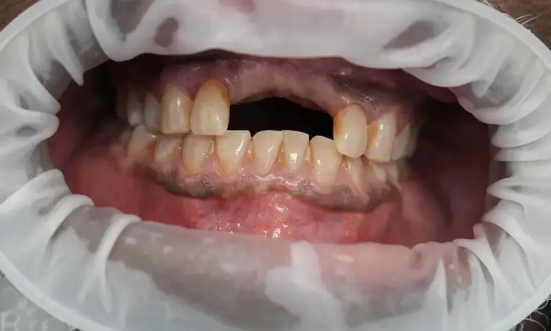 Foto antes del tratamiento dental del paciente 6